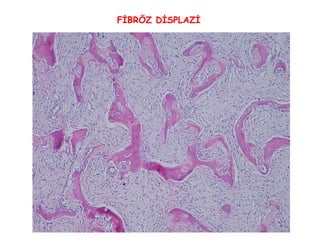 FİBRÖZ DİSPLAZİ 