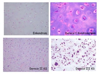 Derece I Kondrosarkom Derece II KS Derece III KS Enkondrom 