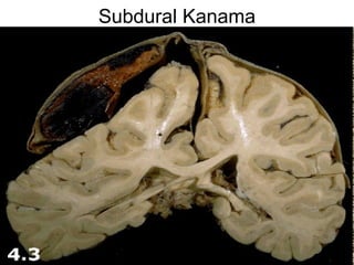 Subdural Kanama 