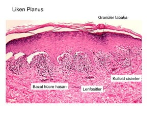 Liken Planus Granüler tabaka Bazal hücre hasarı Kolloid cisimler Lenfositler 
