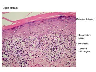 Bazal hücre  hasarı Lenfosit  infiltrasyonu Liken planus Melanofaj Granüler tabaka 