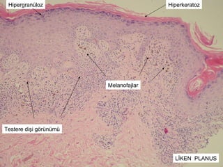 Hiperkeratoz Hipergranüloz Testere dişi görünümü Melanofajlar LİKEN  PLANUS 