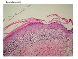 Likenoid dermatit 
