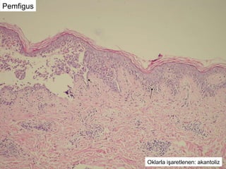 Pemfigus Oklarla işaretlenen: akantoliz 