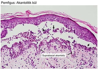 Pemfigus: Akantolitik bül Suprabazal akantoliz 
