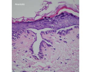 Akantoliz 