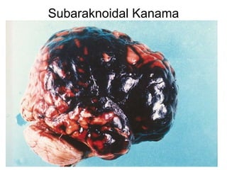 Subaraknoidal Kanama 