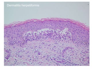 Dermatitis herpetiformis 