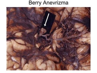 Berry Anevrizma 
