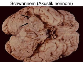 Schwannom (Akustik nörinom) 