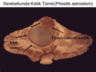 Serebellumda Kistik Tümör(Pilositik astrositom) Kist sıvısı Tümör(mural nodül) 
