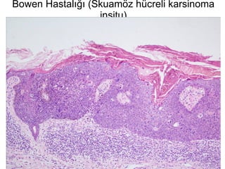 Bowen Hastalığı (Skuamöz hücreli karsinoma insitu) 