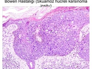 Bowen Hastalığı (Skuamöz hücreli karsinoma insitu) 