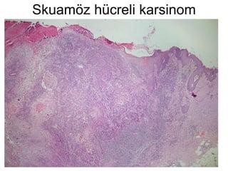 Skuamöz hücreli karsinom 