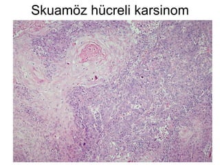Skuamöz hücreli karsinom 