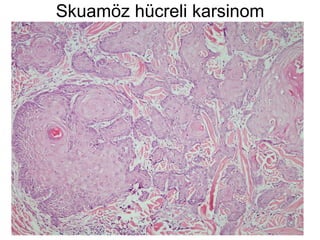 Skuamöz hücreli karsinom 