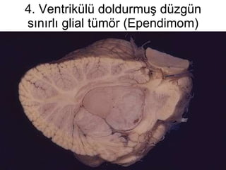 4. Ventrikülü doldurmuş düzgün sınırlı glial tümör (Ependimom) 