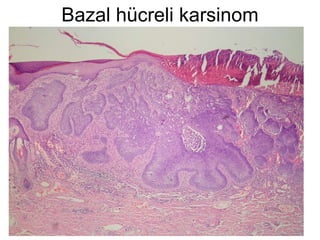 Bazal hücreli karsinom 