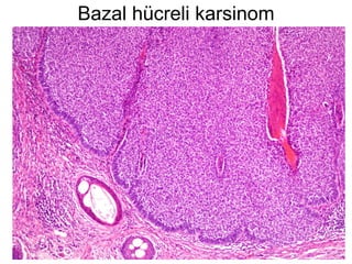 Bazal hücreli karsinom 