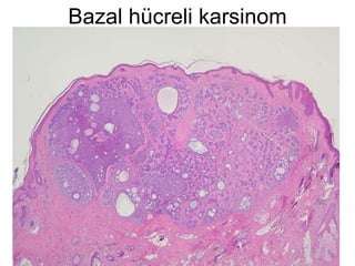 Bazal hücreli karsinom 