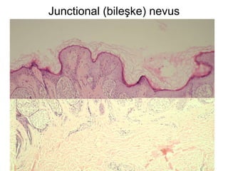 Junctional (bileşke) nevus 