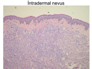 İntradermal nevus 