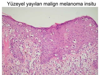 Yüzeyel yayılan malign melanoma insitu 