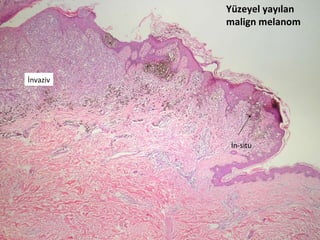 Yüzeyel yayılan malign melanom İn-situ İnvaziv 