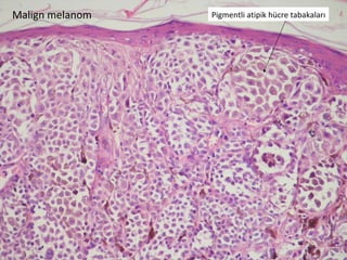 Pigmentli atipik hücre tabakaları Malign melanom 