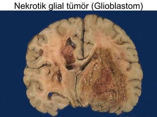 Nekrotik glial tümör (Glioblastom) 
