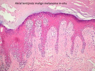 Akral lentijinöz malign melanoma in-situ 