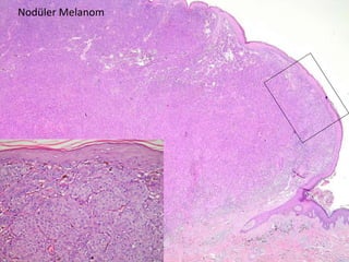 Nodüler Melanom 