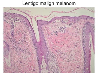 Lentigo malign melanom 