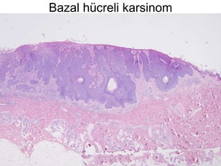 Bazal hücreli karsinom 