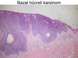 Bazal hücreli karsinom 