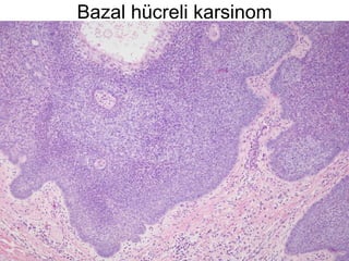 Bazal hücreli karsinom 
