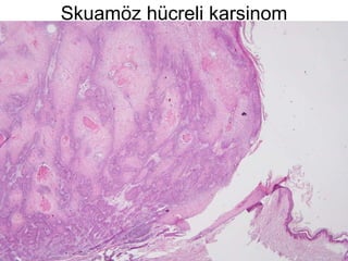 Skuamöz hücreli karsinom 