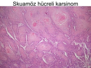 Skuamöz hücreli karsinom 