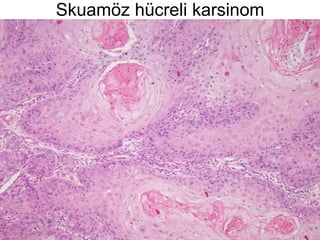 Skuamöz hücreli karsinom 