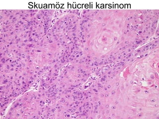 Skuamöz hücreli karsinom 