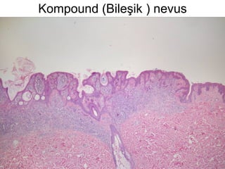 Kompound (Bileşik ) nevus 