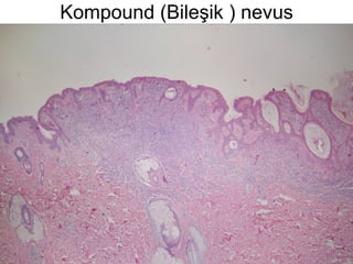 Kompound (Bileşik ) nevus 