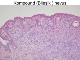 Kompound (Bileşik ) nevus 