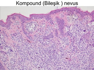 Kompound (Bileşik ) nevus 