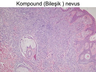 Kompound (Bileşik ) nevus 