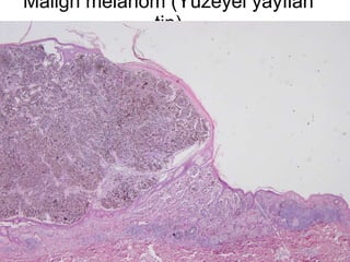 Malign melanom (Yüzeyel yayılan tip) 