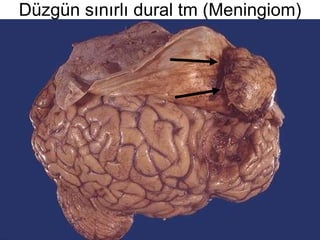 Düzgün sınırlı dural tm (Meningiom) 