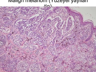 Malign melanom (Yüzeyel yayılan tip) 