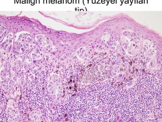 Malign melanom (Yüzeyel yayılan tip) 