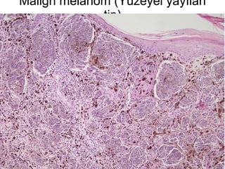 Malign melanom (Yüzeyel yayılan tip) 